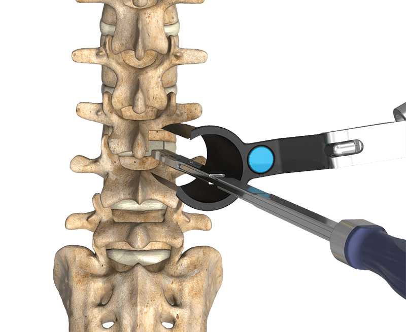 The STAILF implant from Centinel Spine