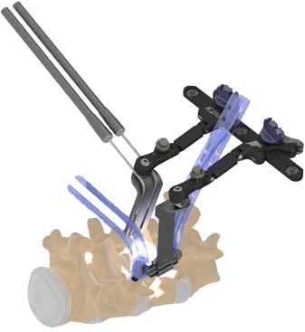 The STAILF implant from Centinel Spine