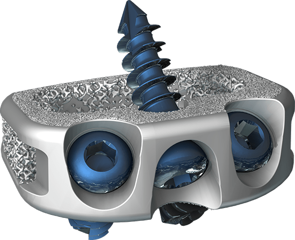 The STAILF implant from Centinel Spine