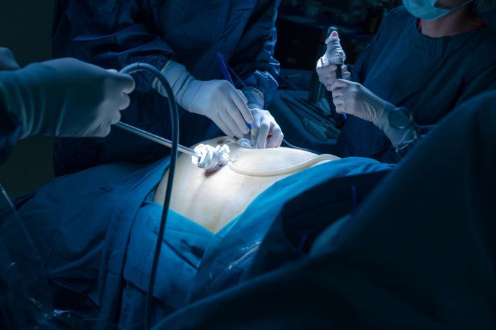 Anterior Lumbar Interbody Fusion  proceedure