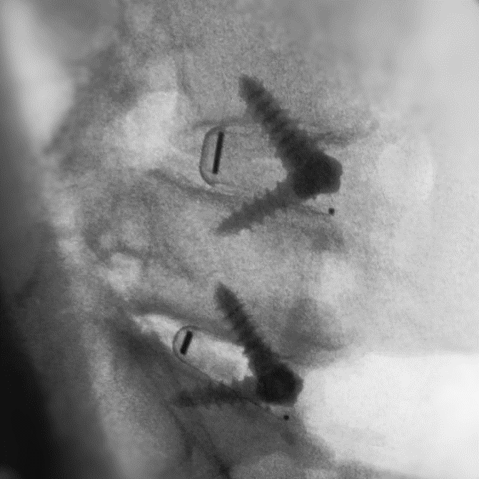 The STALIF line of Integrated Interbody fusion implants